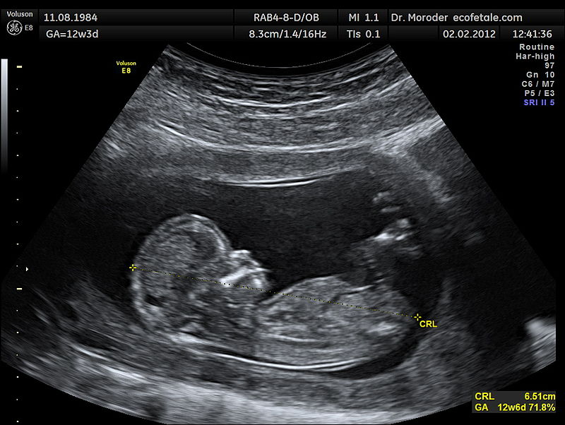 Foetus-Bild